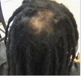 Have Dreadlocks And Suffering From Hair Loss or Thinning